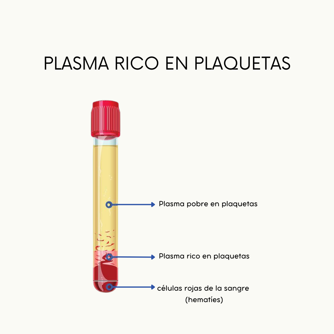 plasma rico plaquetas Terapias de infiltración de sustancias